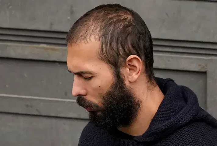 Andrew Tate Hair before Transplant