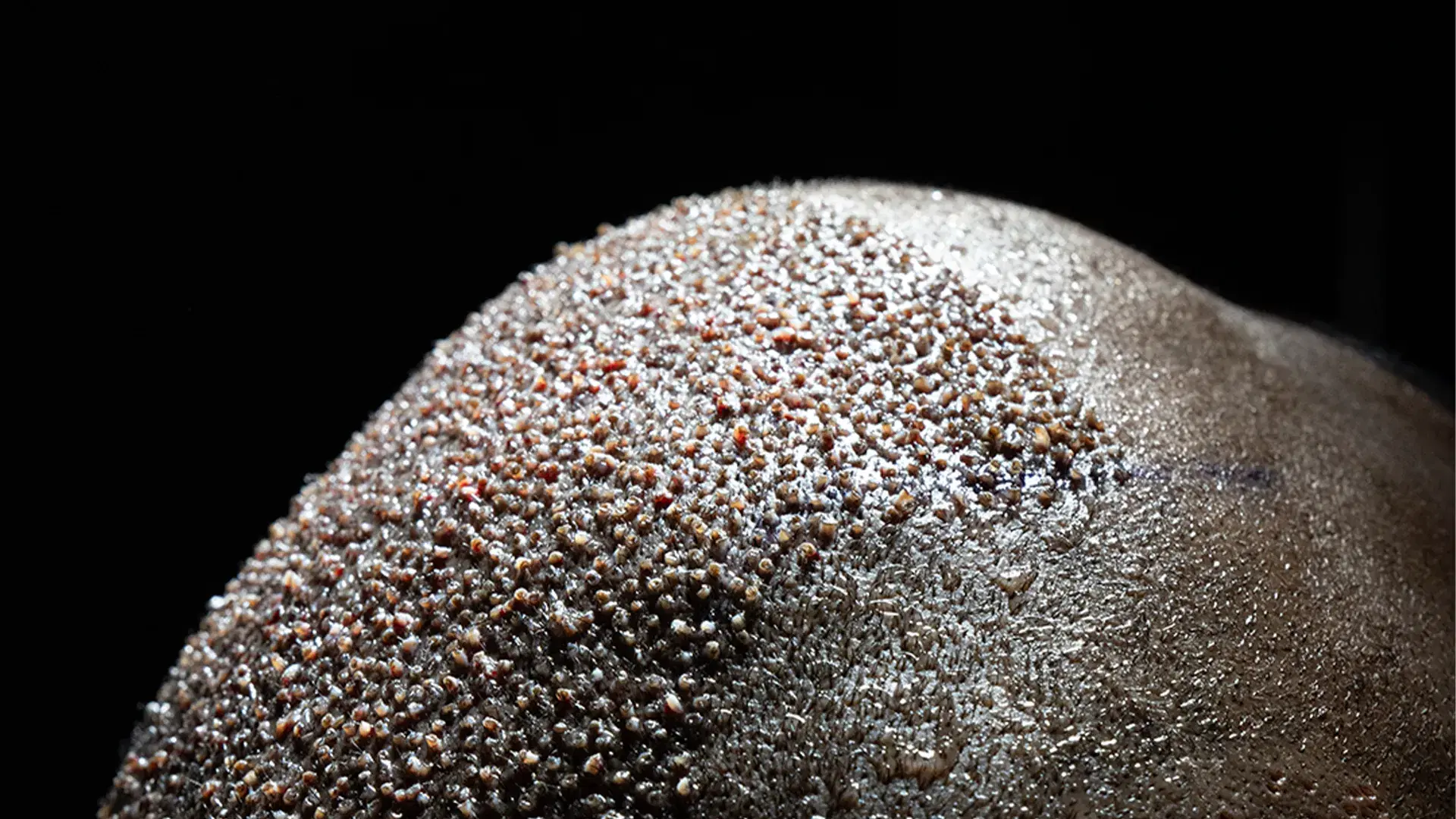 DHI for Afro Hair Transplant