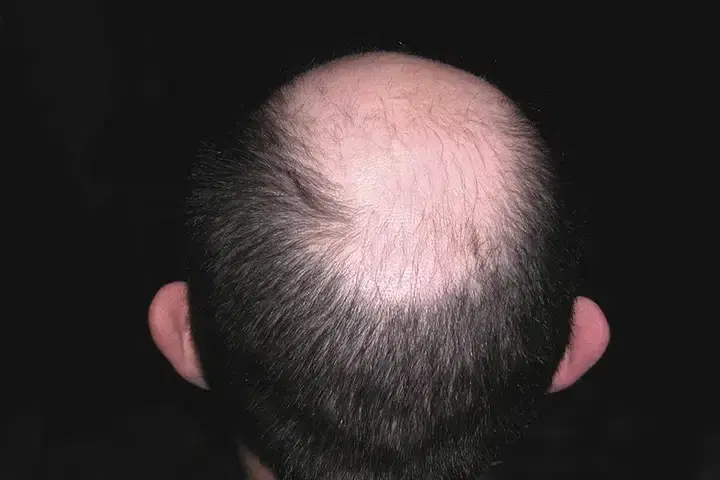 Does Creatine Cause Hair Loss? Myths vs. Facts