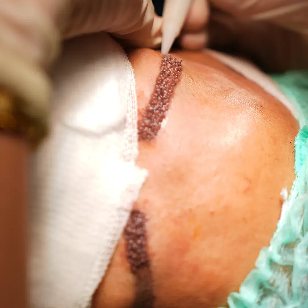 <h3><span style="color: rgb(247, 248, 248);">Graft Preparation and Placement</span></h3><p><span style="color: rgb(74, 78, 90);">&nbsp;</span></p>