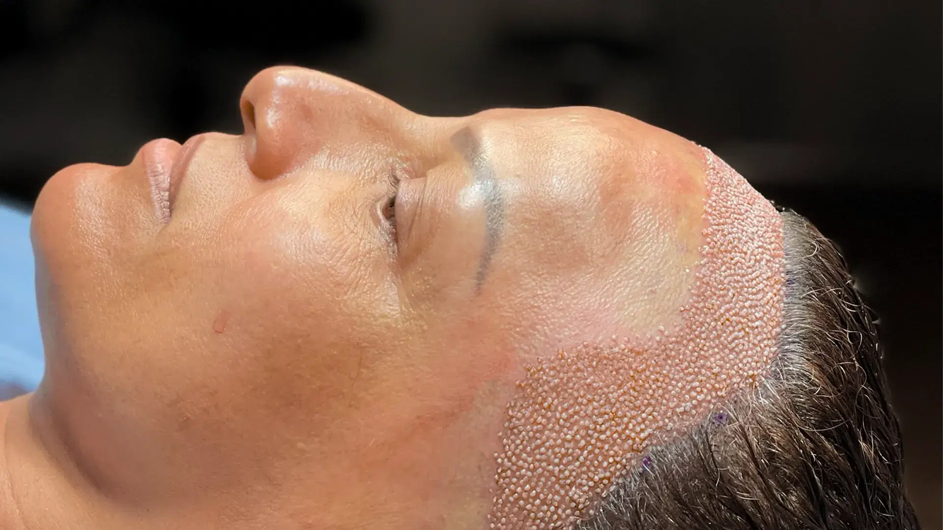 DHI Hair Transplant for women